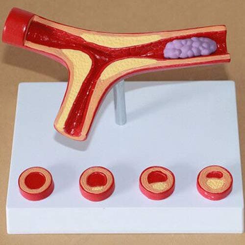 Human Atherosclerosis Cardiovascular Model Blood Vessel Anatomical Model Medical Teaching Supplies 10 Times