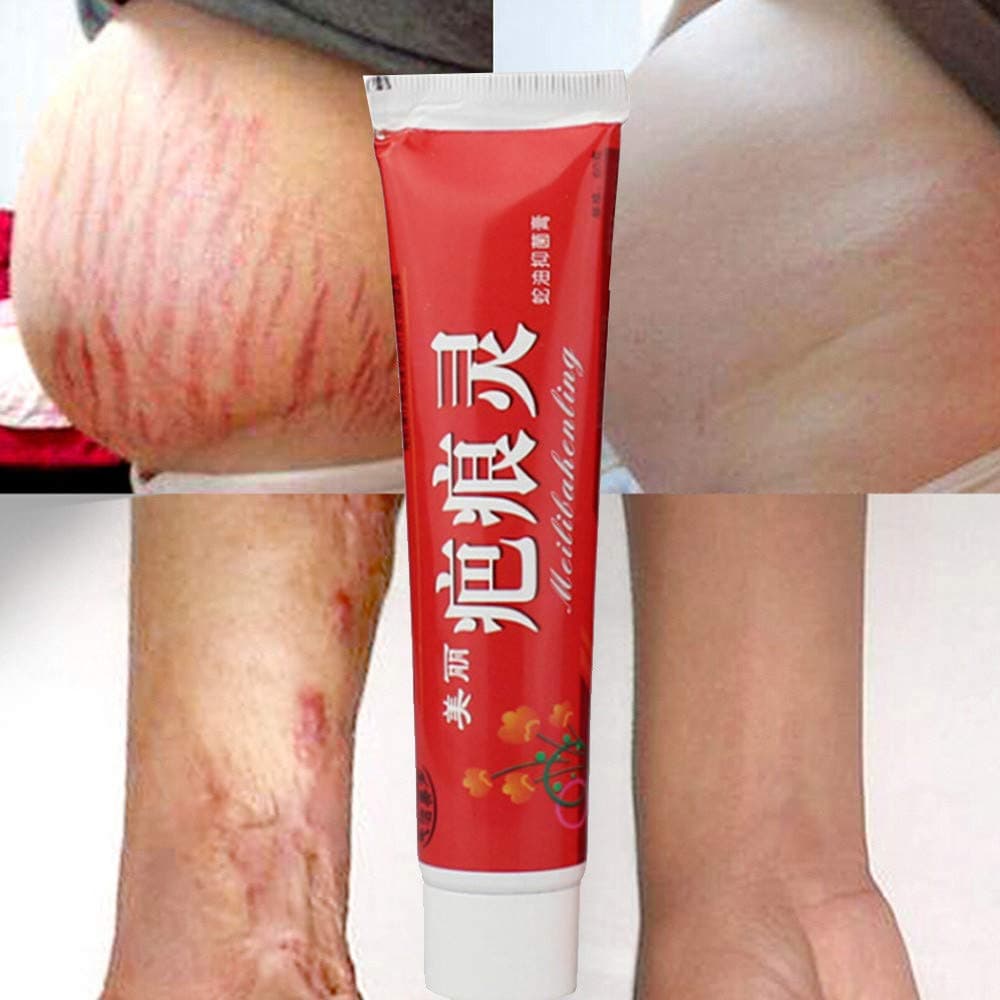 Kashyk Removal Acne Scar, Stretch Marks Pregnancy Remover Cream,Fat Scar Remover, Striae Gravidarum Treatment, Old And New Scars Remover, 60G